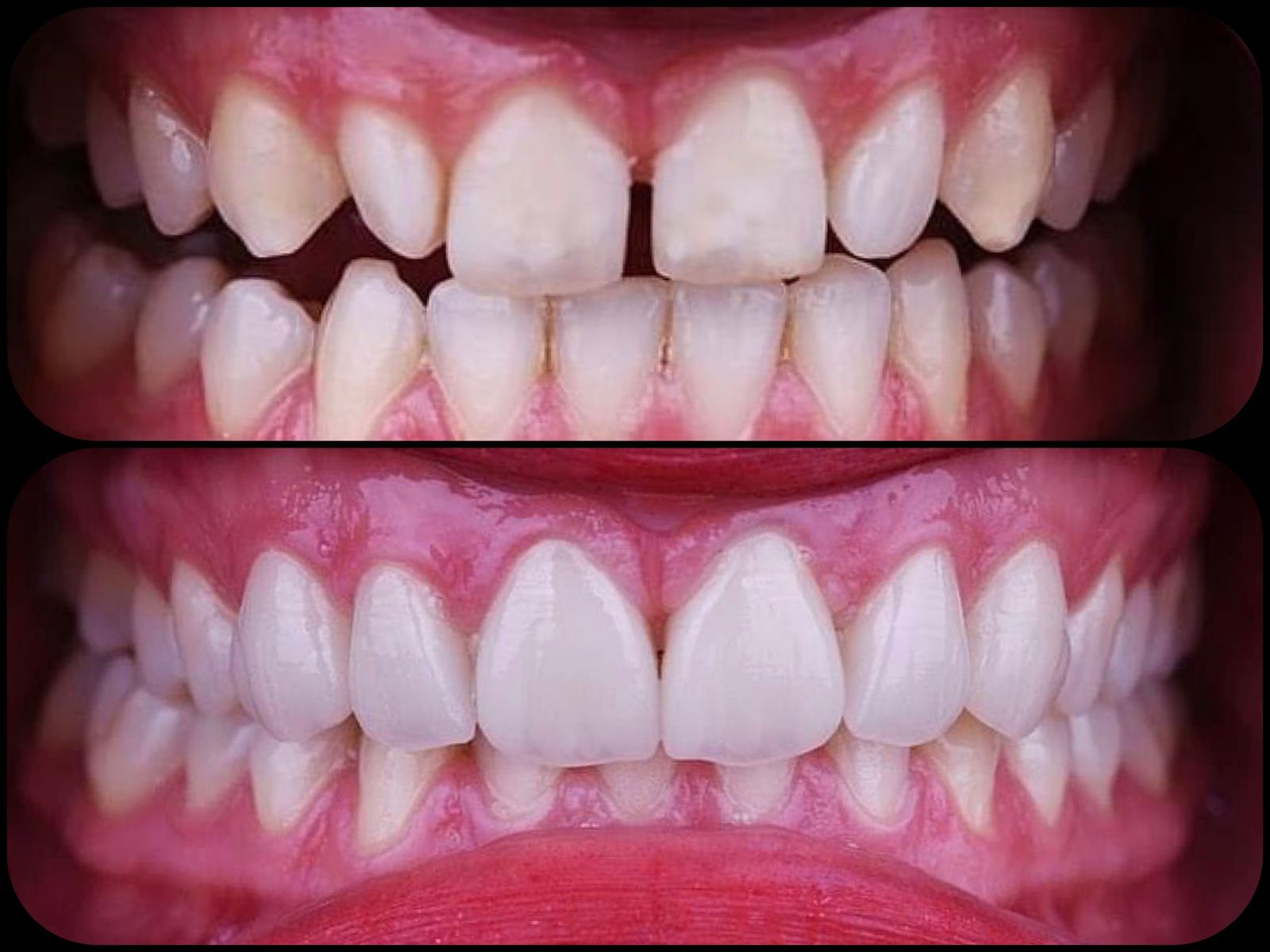 Antes y después — Caso 1 carillas dentales